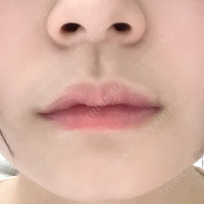 ヒアルロン酸注入（唇） / ボトックス（口角） id美容クリニック 銀座院 AFTER メイン用