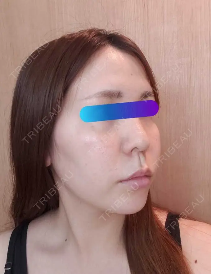 ヒアルロン酸注入（頬） / ヒアルロン酸注入（こめかみ） 加藤クリニック 麻布東京院 DAY 1 メイン用