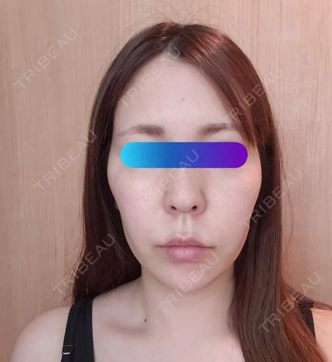 ヒアルロン酸注入（頬） / ヒアルロン酸注入（こめかみ） 加藤クリニック 麻布東京院 DAY 1 メイン用