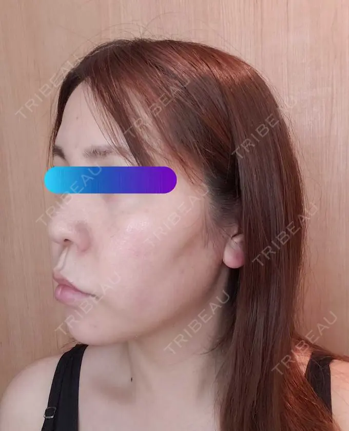 ヒアルロン酸注入（頬） / ヒアルロン酸注入（こめかみ） 加藤クリニック 麻布東京院 DAY 1 メイン用