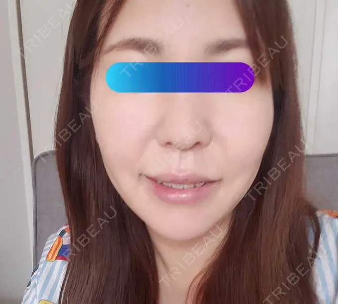 ヒアルロン酸注入（頬） / ヒアルロン酸注入（こめかみ） 加藤クリニック 麻布東京院 AFTER メイン用