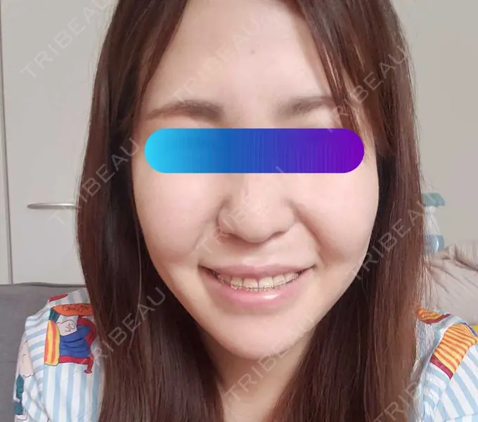 ヒアルロン酸注入（頬） / ヒアルロン酸注入（こめかみ） 加藤クリニック 麻布東京院 DAY 18 メイン用