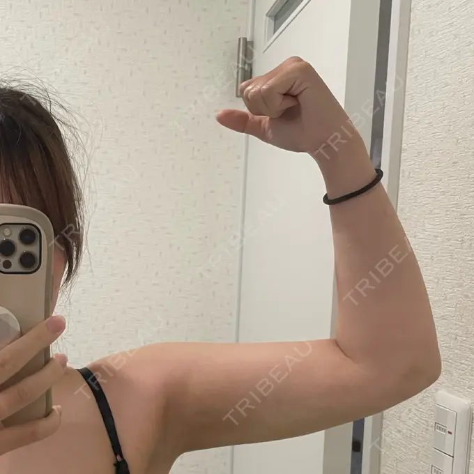 脂肪吸引（二の腕） / 脂肪吸引（肩） / ボトックス（肩） / ボトックス（首） Mods Clinic（モッズクリニック） 東京院 DAY 14 メイン用