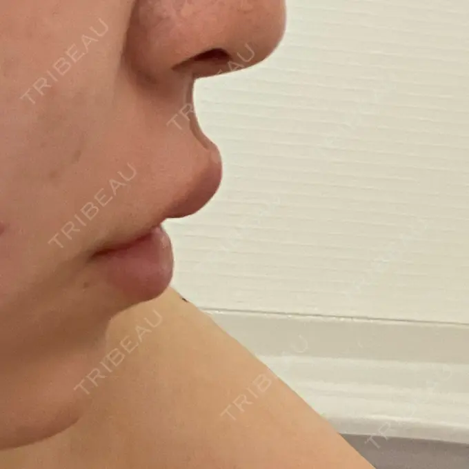 ボトックス（人中） AILE Clinic DAY 1 メイン用