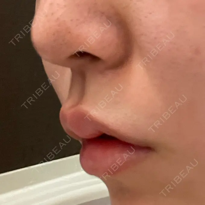 ボトックス（人中） AILE Clinic DAY 1 メイン用