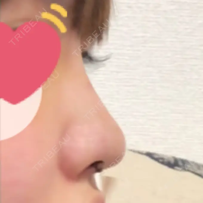 プロテーゼ除去 / 鼻修正 / 鼻孔縁下降 みずほクリニック DAY 2 メイン用