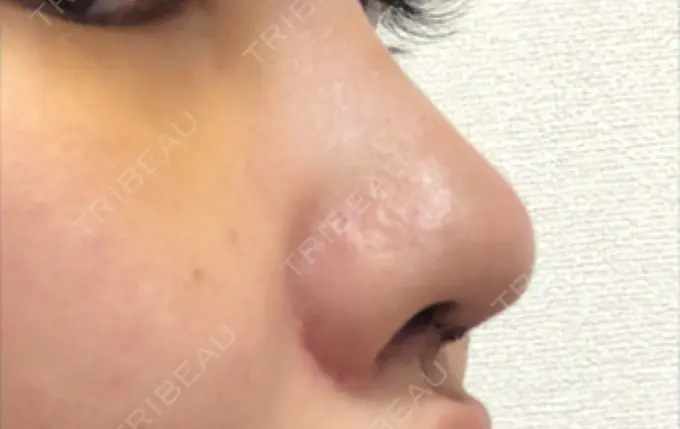 プロテーゼ除去 / 鼻修正 / 鼻孔縁下降 みずほクリニック DAY 4 メイン用