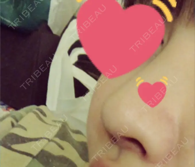 プロテーゼ除去 / 鼻修正 / 鼻孔縁下降 みずほクリニック DAY 24 メイン用