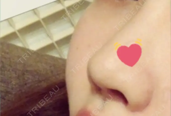 プロテーゼ除去 / 鼻修正 / 鼻孔縁下降 みずほクリニック DAY 27 メイン用