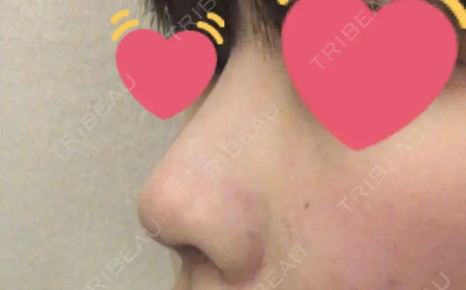 プロテーゼ除去 / 鼻修正 / 鼻孔縁下降 みずほクリニック AFTER メイン用