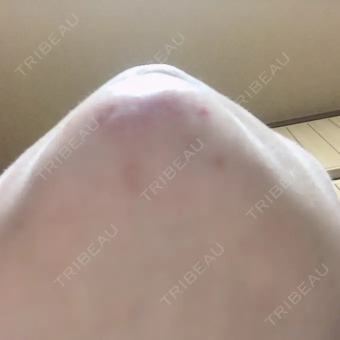 糸リフト / 脂肪吸引（顔） / メーラーファット除去 / ヒアルロン酸注入（あご） 藤・ナチュレ美容クリニック 恵比寿院 DAY 94 メイン用