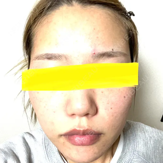 ヴェルヴェットスキン アリエル美容クリニック 大宮院 AFTER メイン用