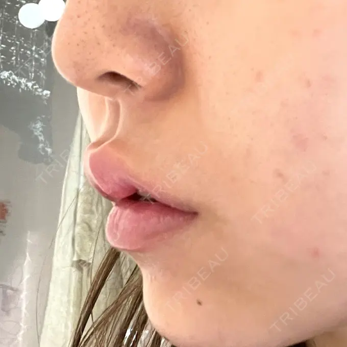 ボトックス（人中） AILE Clinic DAY 3 メイン用