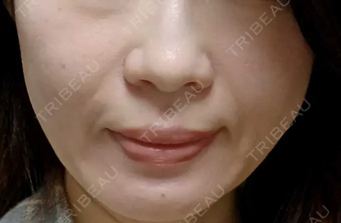 肌ヒアルロン酸注入（たるみ・シワ改善） 恵聖会クリニック 京橋院 AFTER メイン用