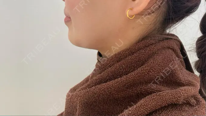 脂肪吸引（顔） 渋谷美容外科クリニック 渋谷院 DAY 27 メイン用