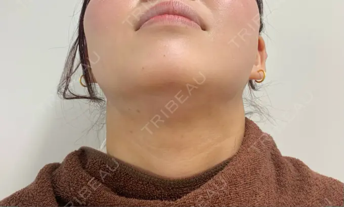 脂肪吸引（顔） 渋谷美容外科クリニック 渋谷院 DAY 27 メイン用