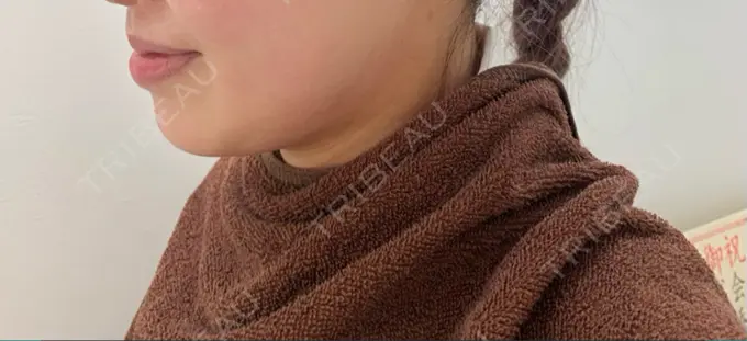 脂肪吸引（顔） 渋谷美容外科クリニック 渋谷院 DAY 27 メイン用