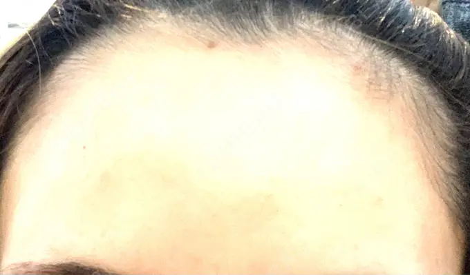 ボトックス（肩） / ボトックス（額） TCB東京中央美容外科 静岡院 AFTER メイン用