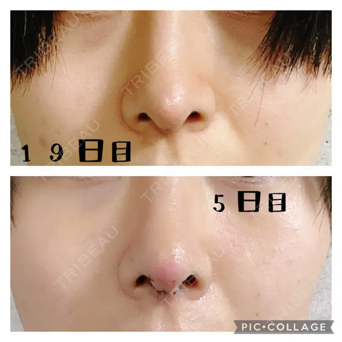 鼻中隔延長（切開） みずほクリニック DAY 19 メイン用