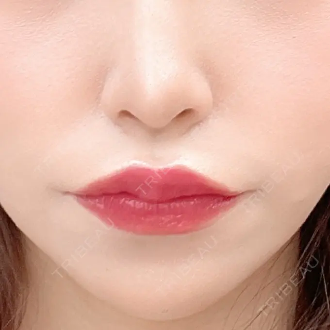 ボトックス（人中） AILE Clinic DAY 5 メイン用