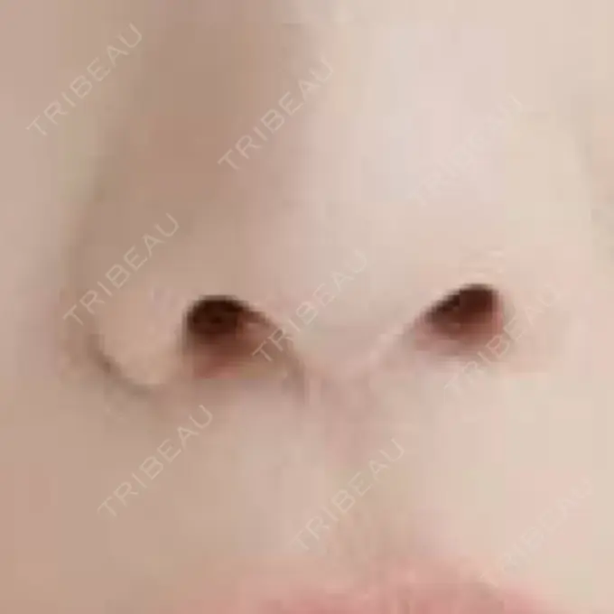 人中短縮 / その他（口元） eクリニック 金沢本院 DAY 392 メイン用