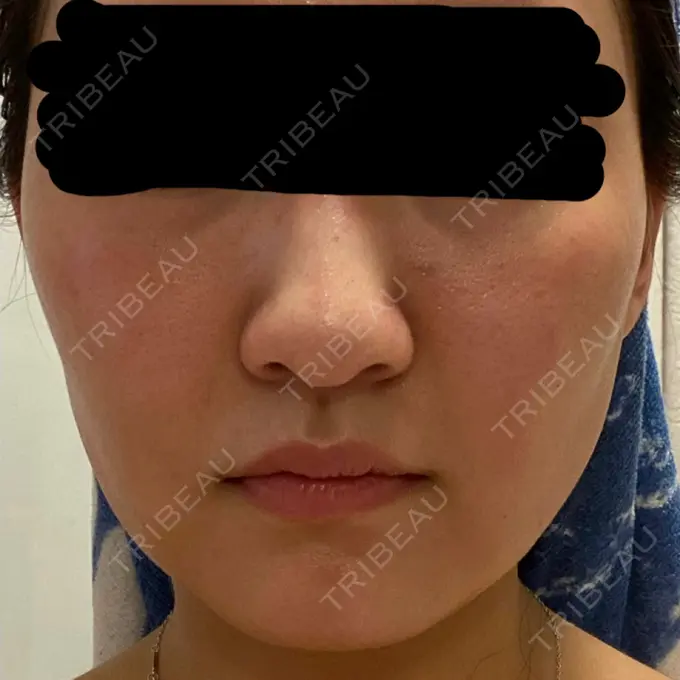 糸リフト / バッカルファット除去 / 脂肪吸引（顔） 東京ミッドクリニック DAY 35 メイン用