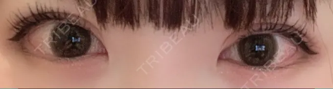 二重切開 / 上まぶたの脂肪取り / その他（目元） CLASSY 仙台美容外科・美容皮膚科 AFTER メイン用