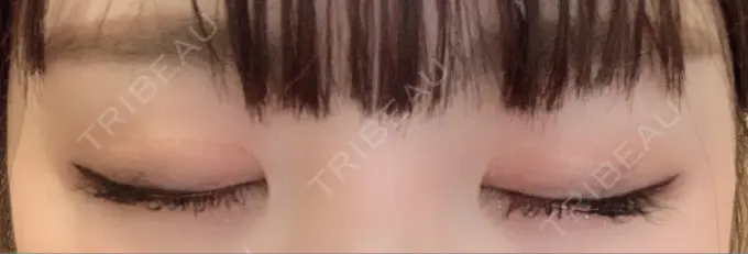 二重切開 / 上まぶたの脂肪取り / その他（目元） CLASSY 仙台美容外科・美容皮膚科 DAY 453 メイン用