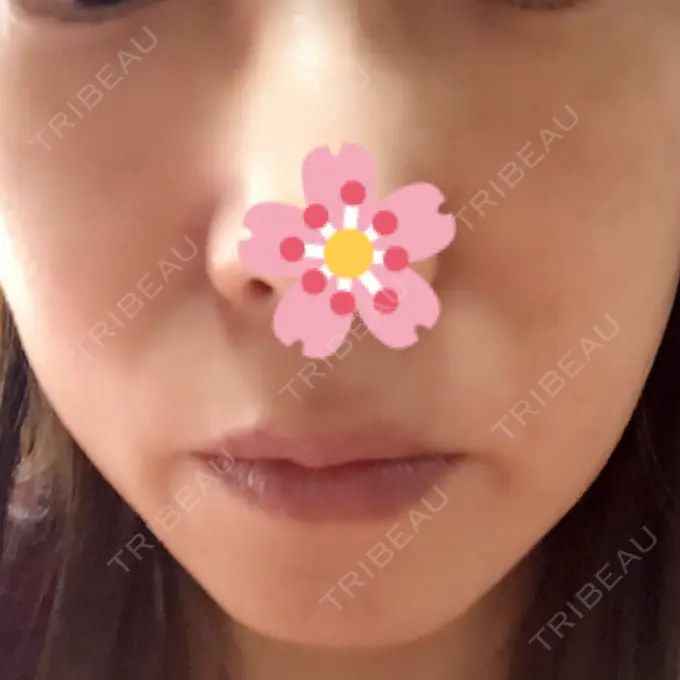 脂肪溶解注射（顔） 湘南美容クリニック 東京蒲田院 DAY 7 メイン用