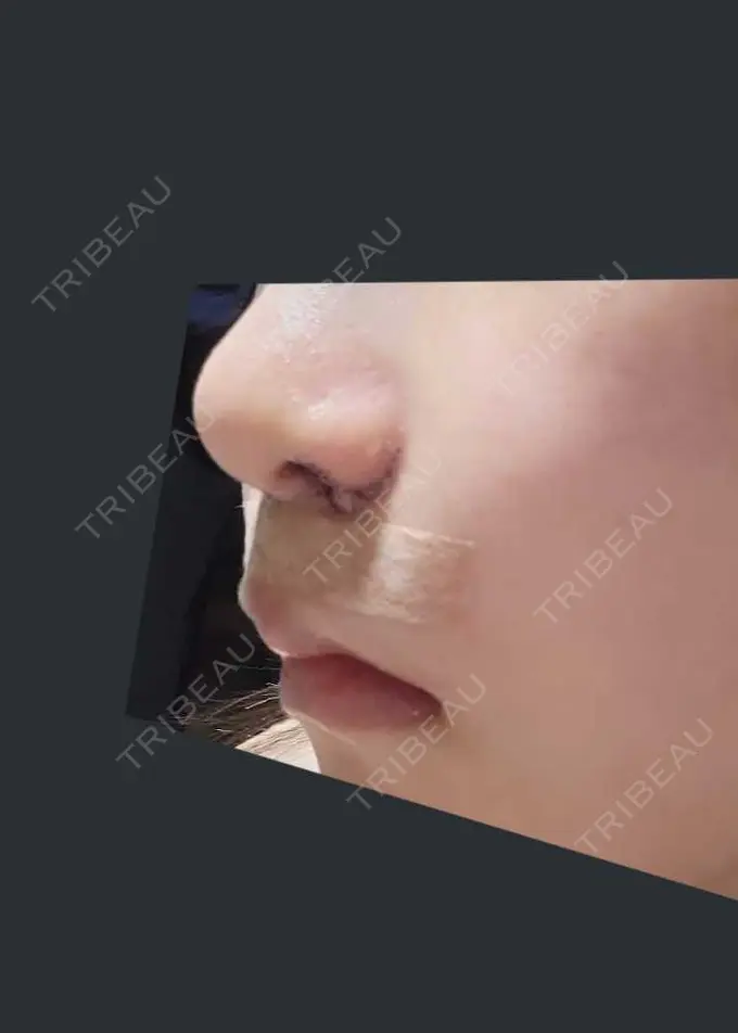 小鼻縮小（切開） くさのたろうクリニック DAY 4 メイン用