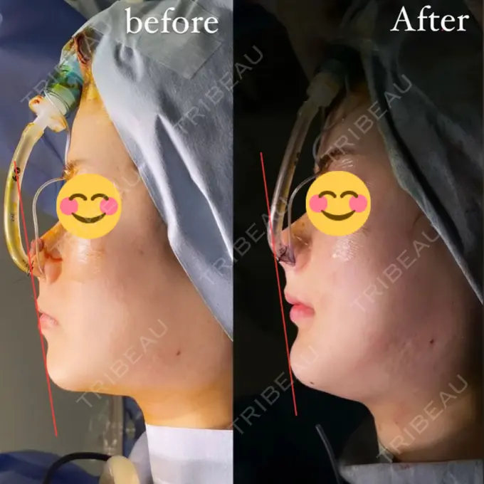 骨切り（あご） / 骨削り（エラ） / セットバック / その他（輪郭） アーククリニック DAY 0 メイン用