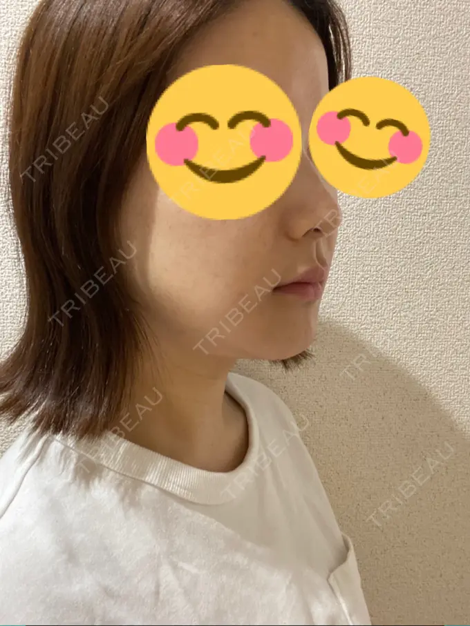 骨切り（あご） / 骨削り（エラ） / セットバック / その他（輪郭） アーククリニック DAY 6 メイン用