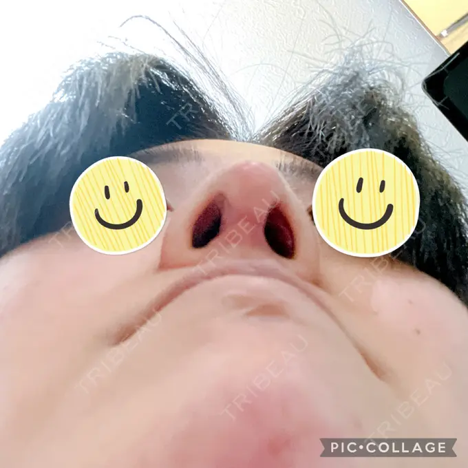 鼻中隔延長（切開） みずほクリニック DAY 24 メイン用