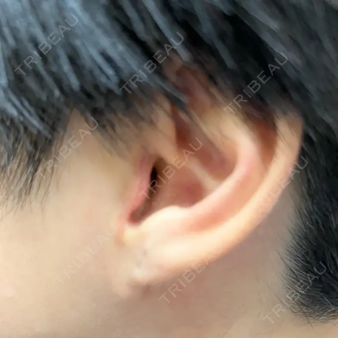 鼻中隔延長（切開） みずほクリニック DAY 24 メイン用