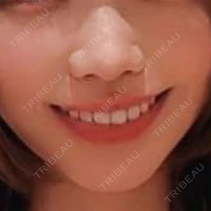 人中短縮 / その他（口元） eクリニック 金沢本院 AFTER メイン用