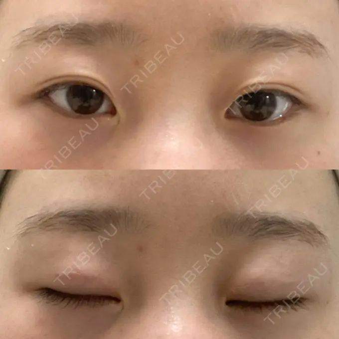 二重埋没 大西皮フ科形成外科医院 滋賀大津石山院 AFTER メイン用