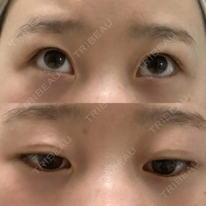 二重埋没 大西皮フ科形成外科医院 滋賀大津石山院 DAY 31 メイン用