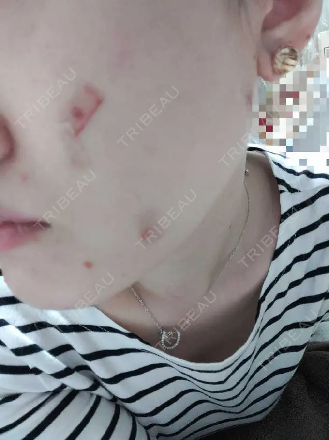 シミ取りレーザー 小田原マタニティクリニック DAY 0 メイン用