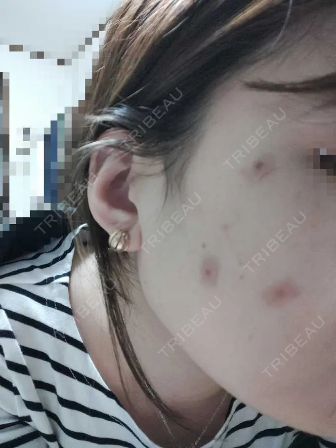 シミ取りレーザー 小田原マタニティクリニック DAY 0 メイン用