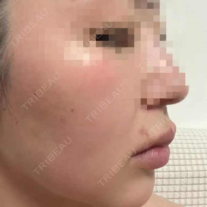 ヒアルロン酸注入（唇） / ボトックス（口角） ルラ美容クリニック 大阪本院 DAY 2 メイン用