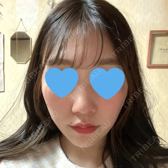 糸リフト / 脂肪吸引（顔） 湘南美容クリニック 長野院 DAY 110 メイン用