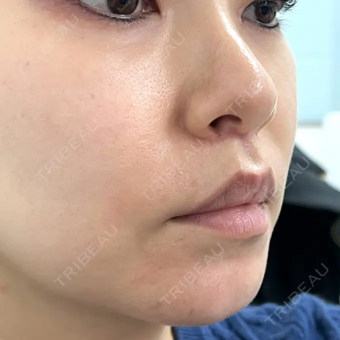 人中短縮 新宿ラクル美容外科クリニック 新宿院 DAY 51 メイン用