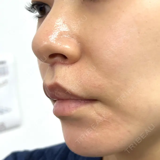 人中短縮 新宿ラクル美容外科クリニック 新宿院 DAY 51 メイン用