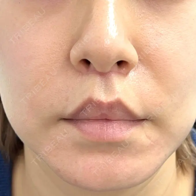 人中短縮 新宿ラクル美容外科クリニック 新宿院 DAY 51 メイン用