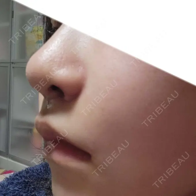 小鼻縮小（切開） くさのたろうクリニック DAY 6 メイン用