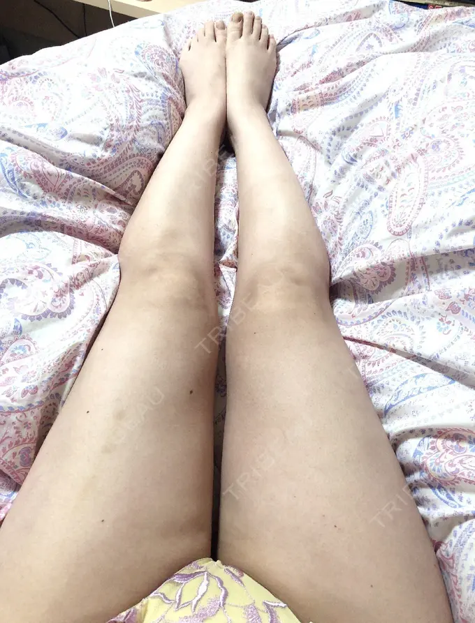 脂肪吸引（脚） / 脂肪吸引（お尻） / ボトックス（ふくらはぎ） ラインカルチャークリニック DAY 34 メイン用