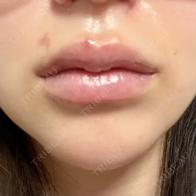 ヒアルロン酸注入（唇） / ボトックス（口角） ルラ美容クリニック 大阪本院 DAY 3 メイン用