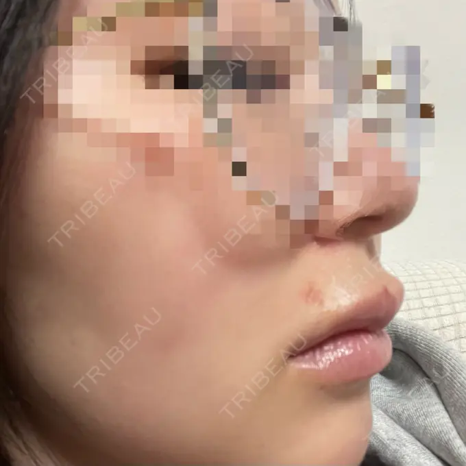 ヒアルロン酸注入（唇） / ボトックス（口角） ルラ美容クリニック 大阪本院 DAY 3 メイン用