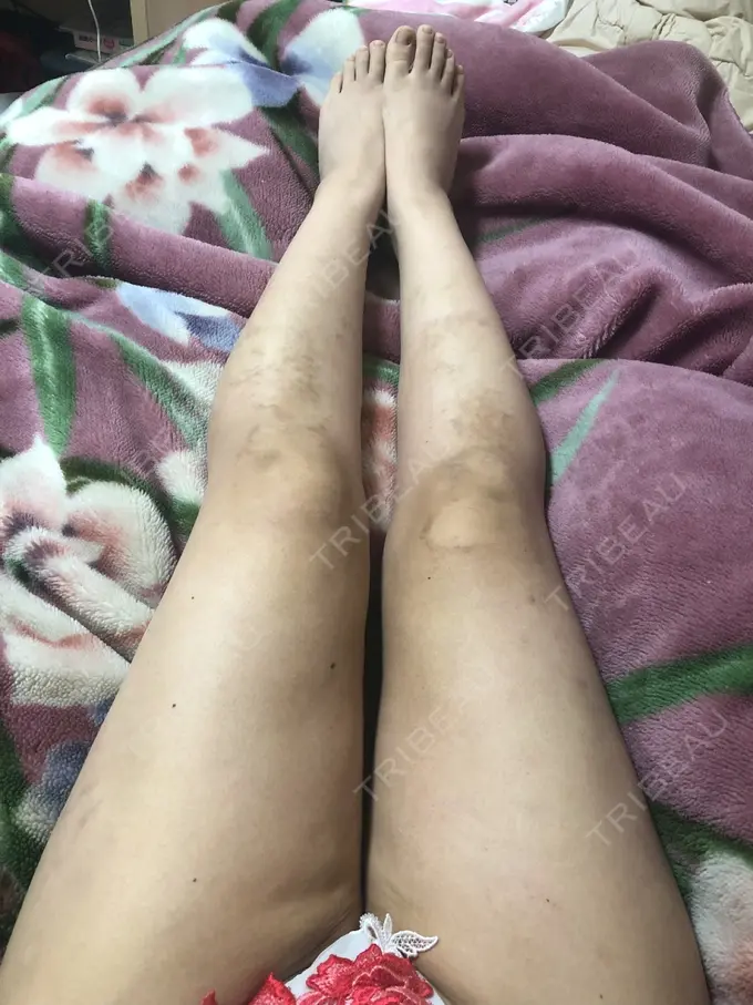 脂肪吸引（脚） / 脂肪吸引（お尻） / ボトックス（ふくらはぎ） ラインカルチャークリニック DAY 26 メイン用