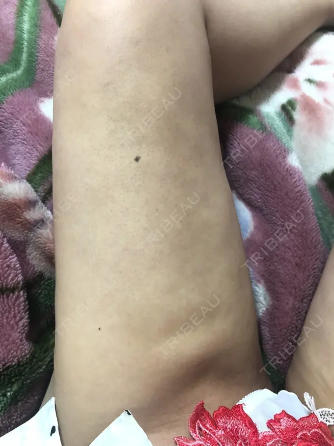 脂肪吸引（脚） / 脂肪吸引（お尻） / ボトックス（ふくらはぎ） ラインカルチャークリニック DAY 26 メイン用